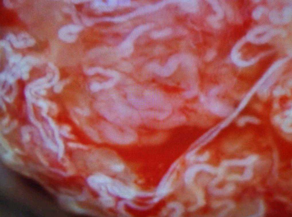 显微取精联合单精冷冻行ICSI助孕治疗（典型案例）